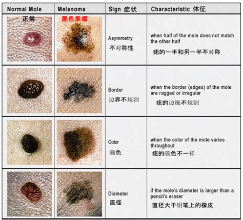 手臂有黑痣|痣也可能会癌变！长在 3 个地方要注意